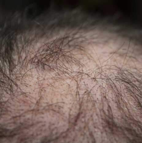 Naturheilkunde - Kreisrunder Haarausfall