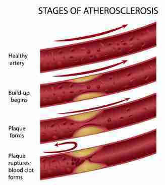 Arterienverkalkung