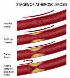 Risikofaktoren für eine Arteriosklerose