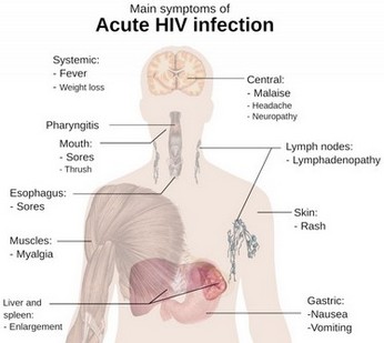 HIV-Infektion - Naturheilkunde