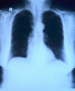 Lungenmilzbrand- Infektion mit Bacillus anthracis