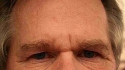 Stirnfalten als Anzeichen für Atherosklerose