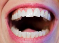 Entzündung - der Zähne