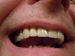 Zahnverfärbungen - Ursachen
