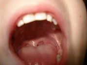 Entzündung der Mundschleimhaut